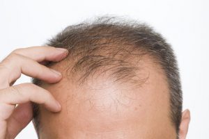 Tóc rụng nhiều ở nam: Nguyên nhân và cách trị rụng tóc cho nam hiệu quả tại nhà