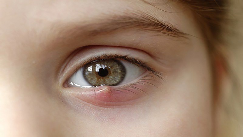 Lẹo mắt là biểu hiện rõ cho thấy mắt bạn đã bị nhiễm trùng
