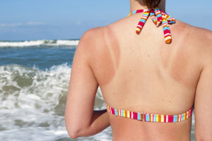 Sunburned woman at beach