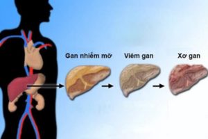 Cây chó đẻ chữa bệnh máu nhiễm mỡ?