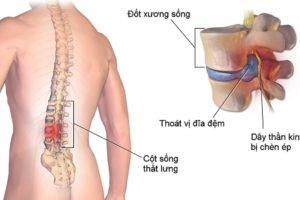 Thoát vị đĩa đệm gây cảm giác tê, đau nhức, khó cử động, hoặc thậm chí là liệt giường