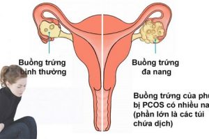 Buồn trứng đa nang - 1 trong những nguyên nhân dẫn đến vô sinh ở phụ nữ