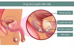 Ảnh minh họa căn bệnh ung thư tuyến tiền liệt