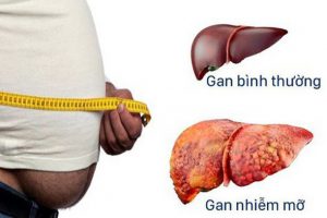 Gan nhiễm mỡ là gì? Nguyên nhân, triệu chứng, cách phòng ngừa