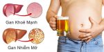 Người làm dụng bia rượu rất dễ bị gan nhiễm mỡ