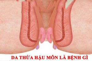 Bệnh trĩ dẫn đến việc hậu môn có cục thịt dư