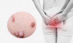 Chữa cục thịt dư ở hậu môn tại nhà đem lại cảm giác thoải mái cho người bệnh