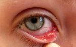 Nguyên nhân gây ra nhiễm trùng mắt