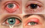 Nhiễm trùng mắt
