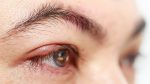 Phòng ngừa bệnh nhiễm trùng mắt như thế nào là đúng