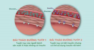 bệnh tiểu đường tuýp 1 và 2
