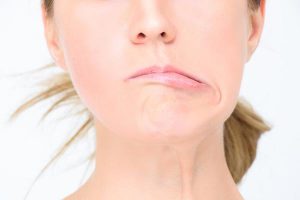 Méo miệng là dấu hiệu đột quỵ thường gặp.