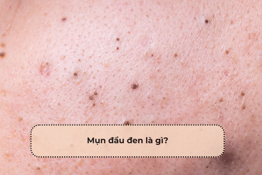 Yoosun Acnes có trị mụn đầu đen hiệu quả không?