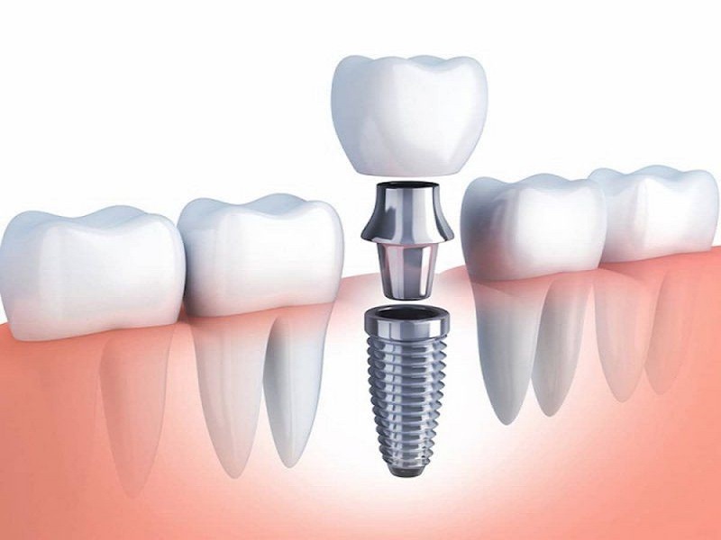 Không phải trường hợp nào trụ Implant cũng tích hợp vào xương hàm