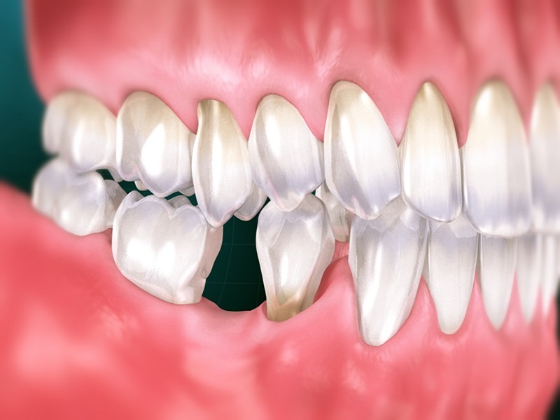 Mất răng có thể gây ra nhiều hậu quả khôn lường nếu không trồng răng Implant sớm