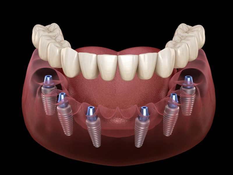 Bệnh nhân có thể chọn các giải pháp trồng răng Implant theo tư vấn của bác sĩ